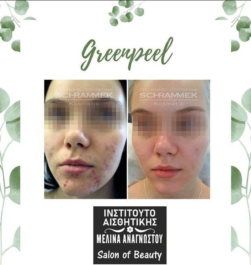 Η αυθεντική μέθοδος Green Peel της Dr.med Christine Schrammek έφτασε στο ινστιτούτο αισθητικής της Μελίνας Αναγνώστου